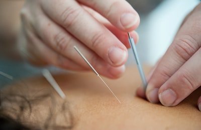 neck pain relief with acupuncture